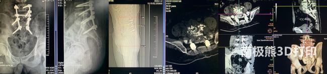 3D打印技術助力脊柱手術，讓患者重獲新生